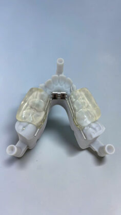 Rapid Hyrax RPE (HD) là khí cụ nong hàm được chế tác chính xác trên mẫu hàm 3D bằng công nghệ CAD/CAM, hỗ trợ điều trị chỉnh nha tại LAB LÝ THƯỜNG KIỆT.