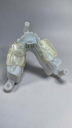 Rapid Hyrax RPE (HD) là khí cụ nong hàm được chế tác chính xác trên mẫu hàm 3D bằng công nghệ CAD/CAM, hỗ trợ điều trị chỉnh nha tại LAB LÝ THƯỜNG KIỆT.