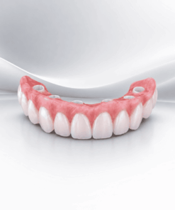 Cầu răng toàn sứ zirconia cố định trên implant