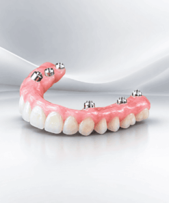 Hybrid Implant Dentures