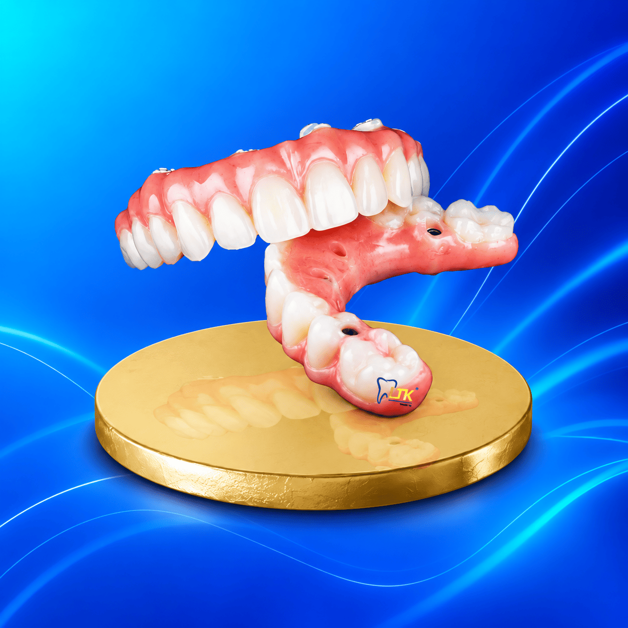 Implant